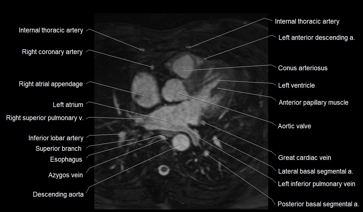 MRI heart coronary arteries and coronary veins anatomy axial image 20.webp